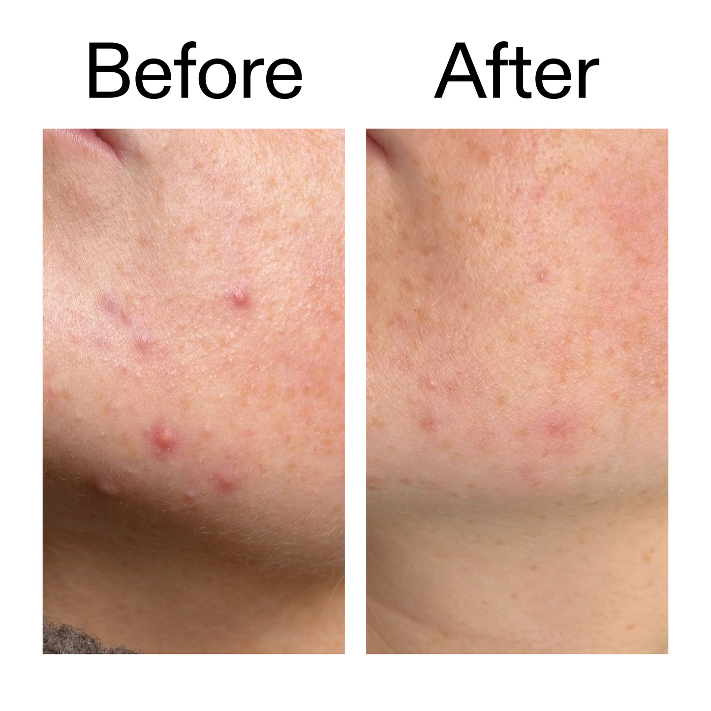 10-azelaic-acid-serum-for-redness-relief-i3 B_A_1_PPAGE.png