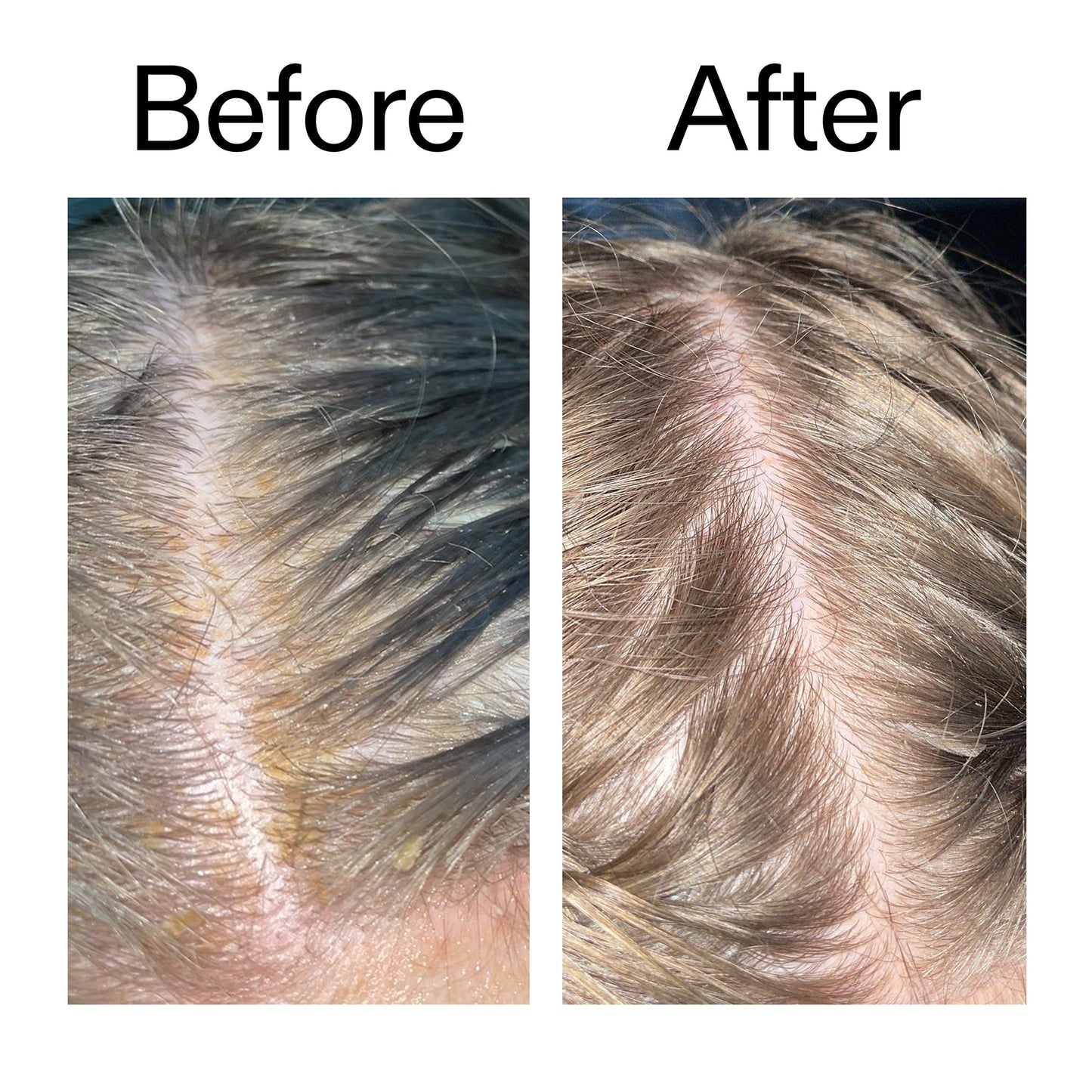 salicylic-acid-exfoliating-scalp-treatment-h2 Salicylic_Acid_Exfoliating_Scalp_Treatment_Before_After_2000x2000_e572a30f-057c-4a48-823b-1c09dc97f8d0.jpg