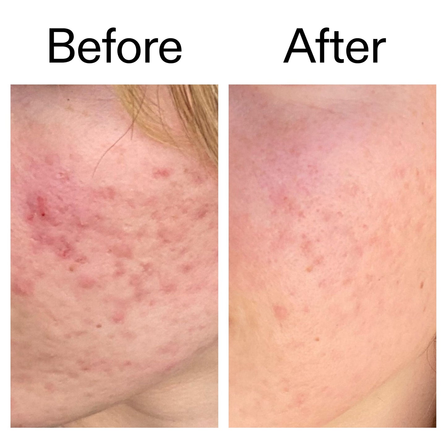 10-azelaic-acid-serum-for-redness-relief-i3 Azealic_Acid_Serum_B_A_Ppage_2000_x_2000.jpg