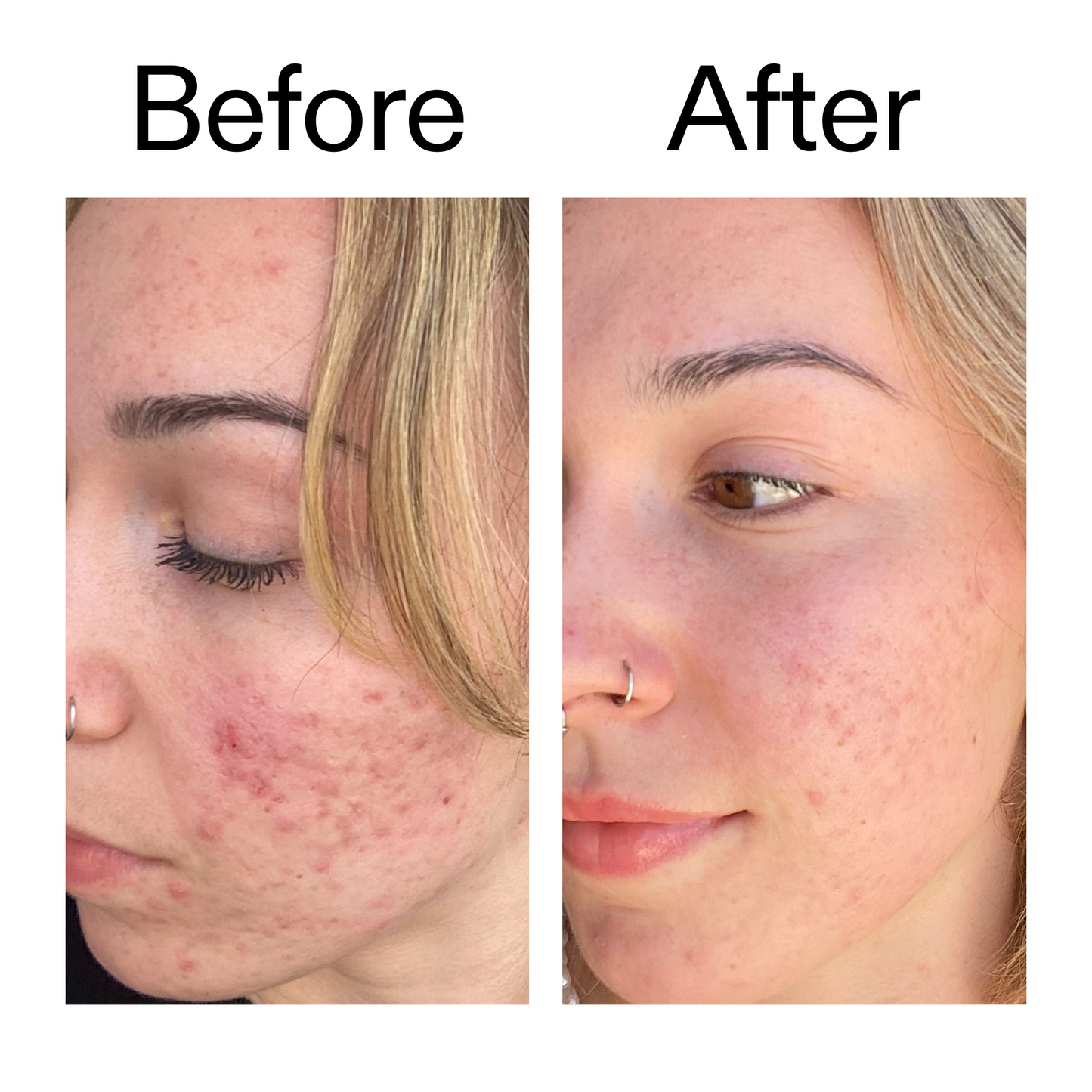 10-azelaic-acid-serum-for-redness-relief-i3 B_A_2_PPAGE.png
