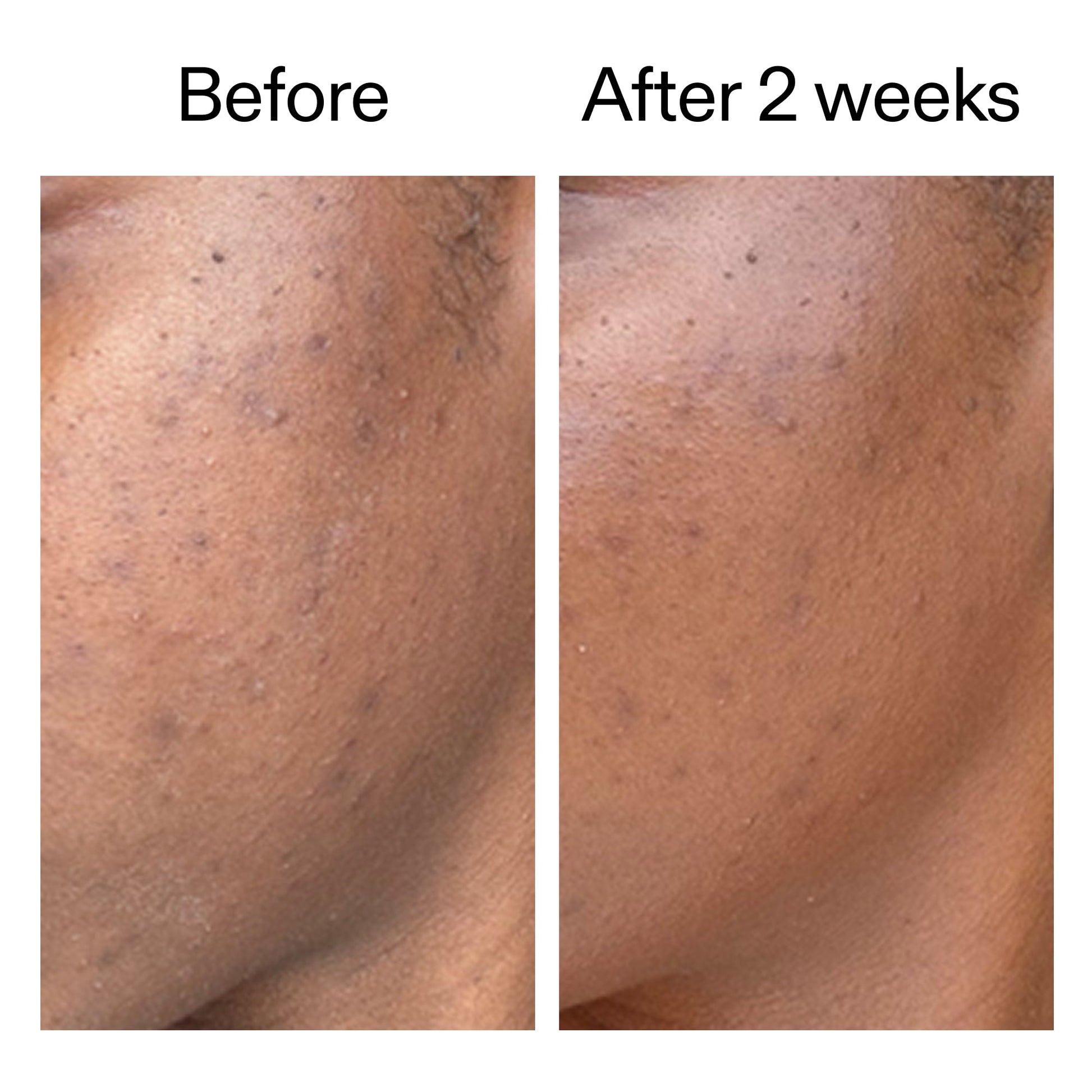 360-acne-clearing-serum-x8 DIOICB_A2000x2000.jpg