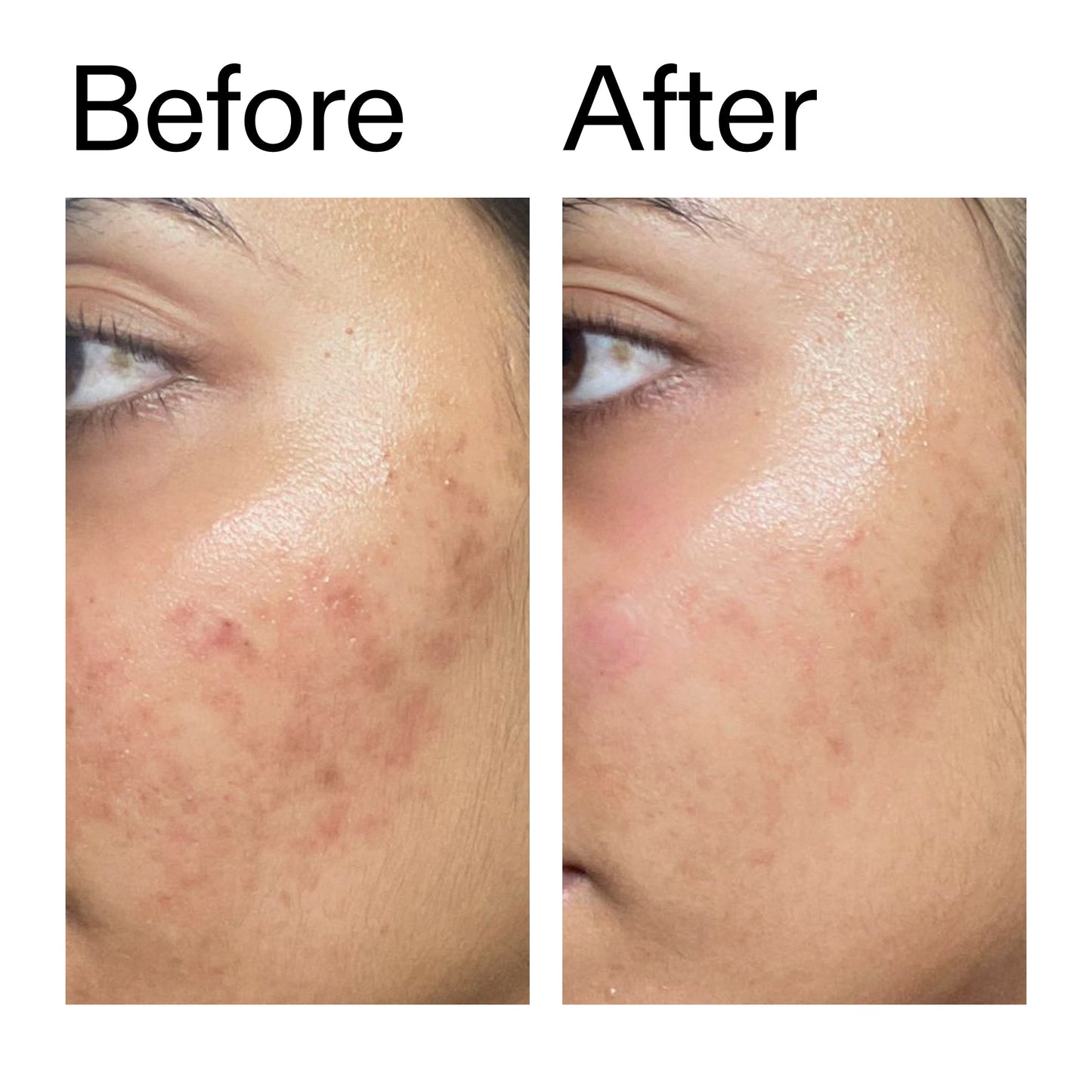 ectoin-hydro-barrier-serum-duo-t9 Ectoin_Hydro-barrier_Serum__Before_After_2000x2000_34261920-d004-48d0-9c7b-8e1c15971bfd.jpg