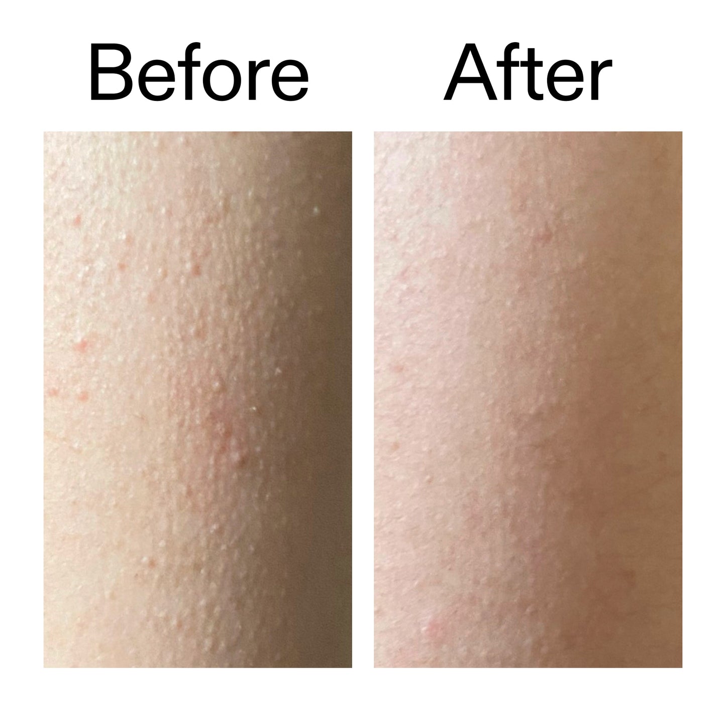 glycolic-acid-exfoliating-body-stick-duo-v5 Glycolic_Acid_Exfoliating_Body_Stick_Before_After_V2_2000x2000_2e4ba052-94f6-4d56-82df-7bdb5b2df7ae.jpg