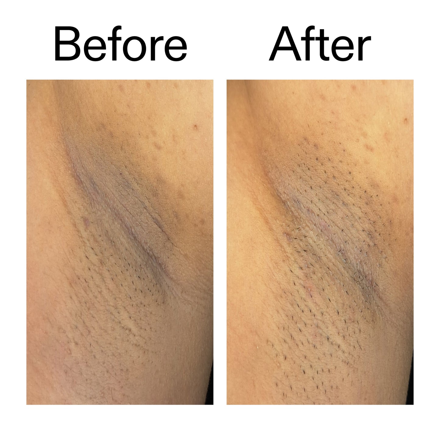glycolic-acid-exfoliating-body-stick-duo-v5 Glycolic_Acid_Exfoliating_Body_Stick_Before_After_V3_2000x2000_ea919cd9-1439-4a46-82a0-76200eb5bb42.jpg