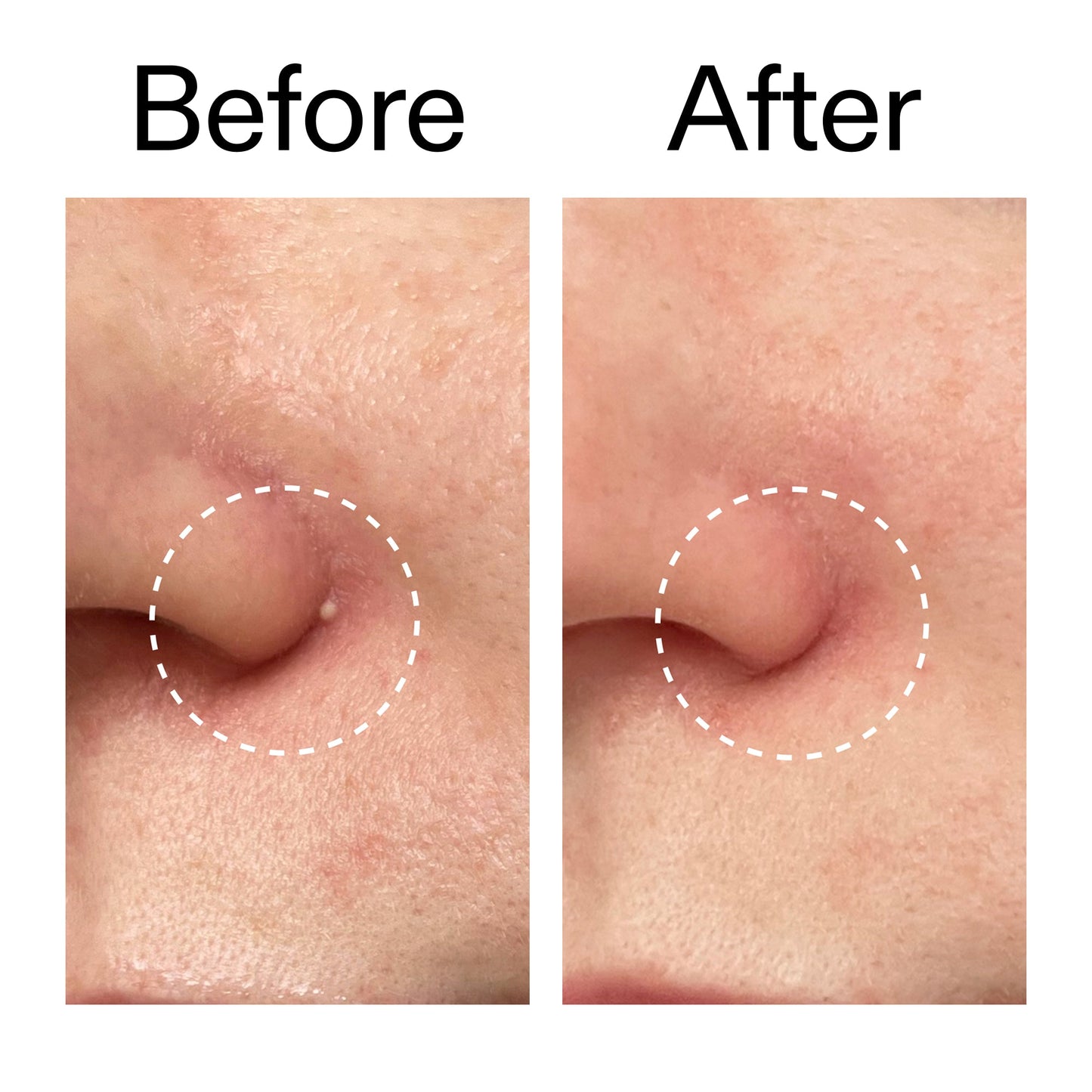 hydrocolloid-invisible-pimple-patches-pack-of-22-u3 Hydrocolloid_Invisible_Pimple_Patches_Before_After_2000x2000_b02aa37b-c78a-4682-91de-9135af5bb7df.jpg