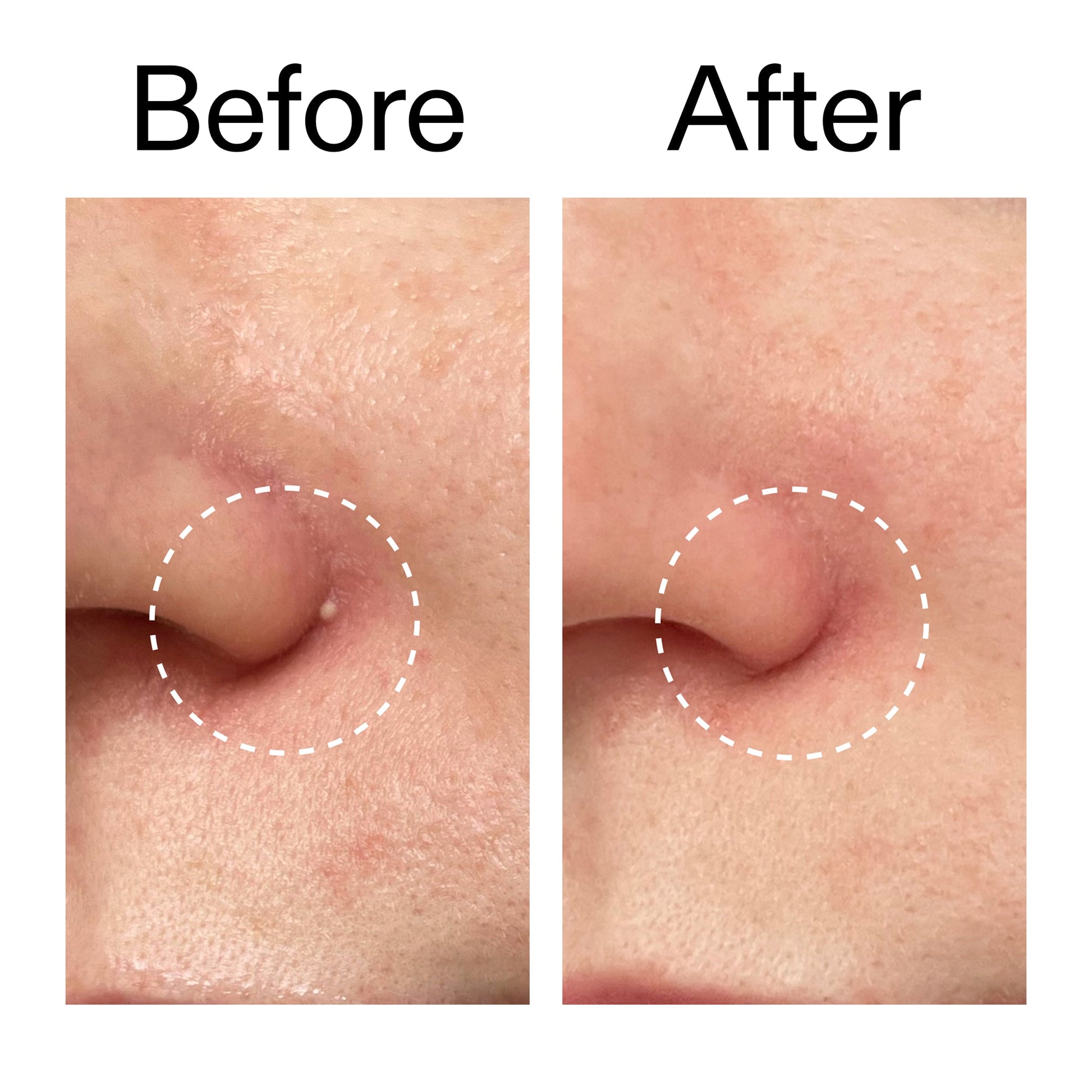 hydrocolloid-invisible-pimple-patches-pack-of-22-u3 Hydrocolloid_Invisible_Pimple_Patches_Before_After_2000x2000_b02aa37b-c78a-4682-91de-9135af5bb7df.jpg