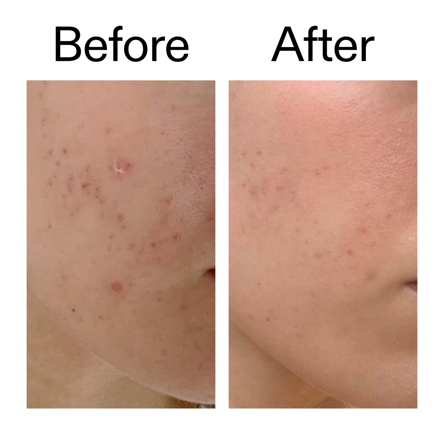 mandelic-acid-treatment-x9 Mandelic_Acid_Treatment_Before_After_2000x2000_4885ac6e-c5d7-4279-a72a-1417af7dce35.jpg