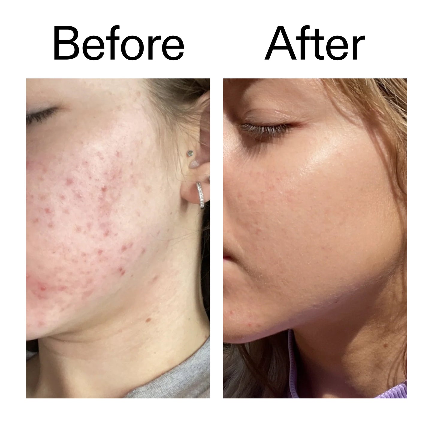 10-niacinamide-serum-m3 Niacinamide_Serum_Before_After_2000x2000_bde32455-9e7d-448e-b053-bef41504f0a9.jpg