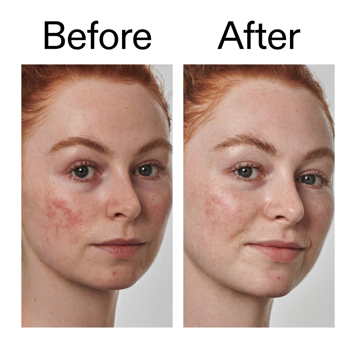 10-azelaic-acid-serum-for-redness-relief-i3 Redness_Relief_Serum_Before_After_2000x2000_3334dc9a-cce9-4e00-8aec-7ad89ca051f2.jpg
