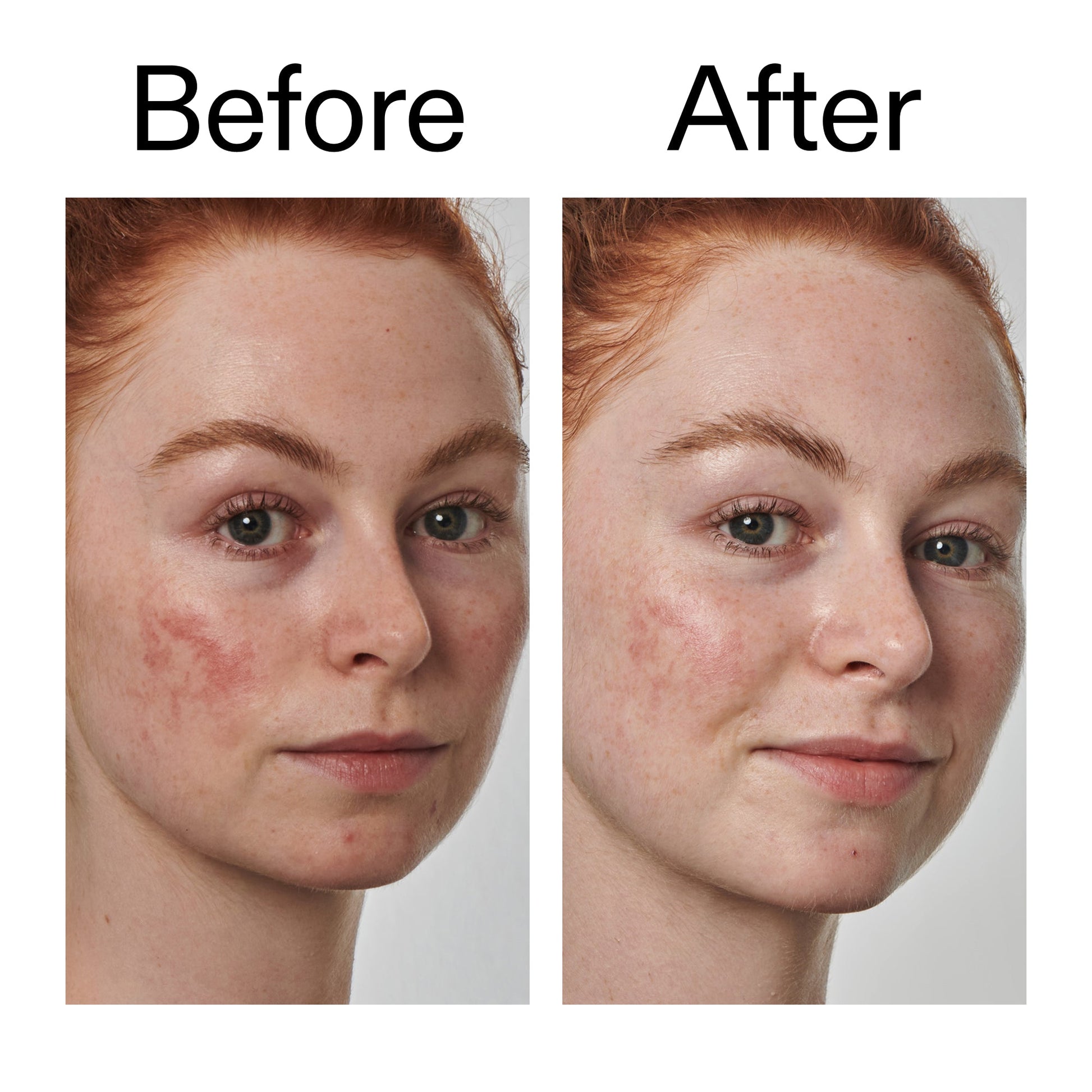 10-azelaic-acid-serum-for-redness-relief-i3 Redness_Relief_Serum_Before_After_2000x2000_3334dc9a-cce9-4e00-8aec-7ad89ca051f2.jpg