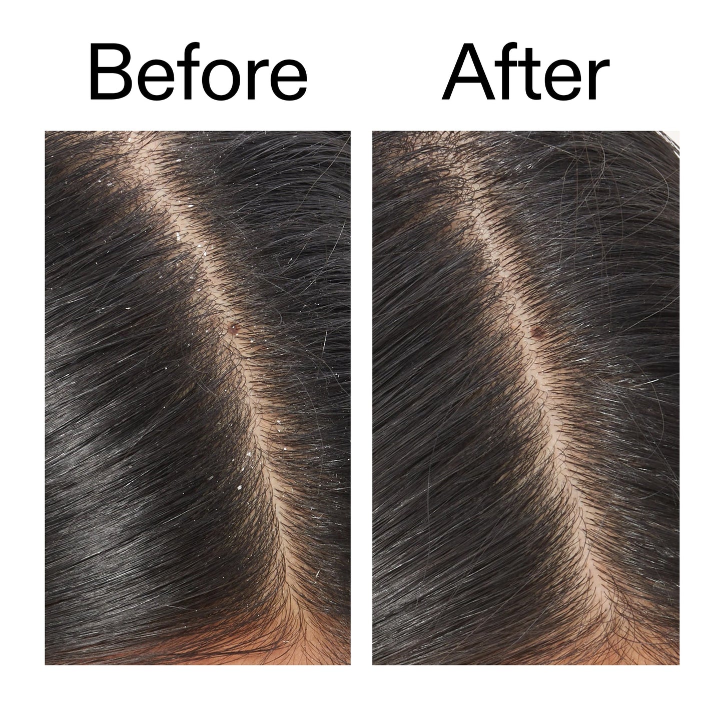 salicylic-acid-exfoliating-scalp-treatment-h2 Salicylic_Acid_Exfoliating_Scalp_Treatment_Before_After_V2_2000x2000_02bd61ad-42bf-490b-b3e3-7e04b2e8a673.jpg