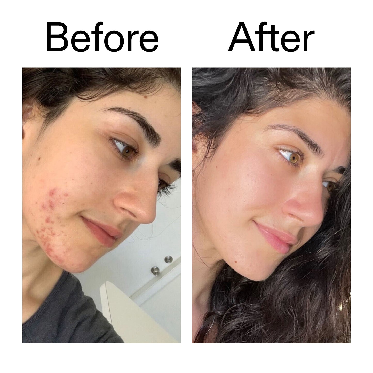 succinic-acid-acne-treatment-g2 Succinic_Acid_Treatment_Before_After_2000x2000_6a5f0054-2f58-4433-9314-0dc72c9bdd3b.jpg